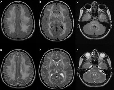 Case report: A patient with mitochondrial neurogastrointestinal encephalomyopathy and chronic intestinal failure